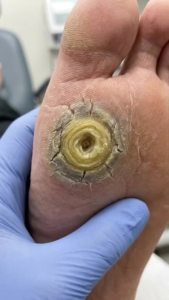#asmrsound #callusremoval #deadskinremoval #dermatology #footcare thumbnail from TikTok