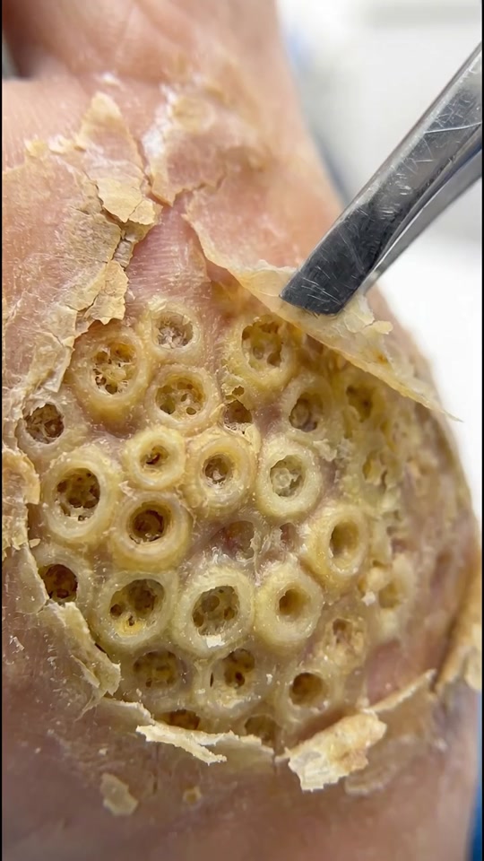 Can you look at these skin holes without getting goosebumps? 🥶👀 thumbnail from TikTok